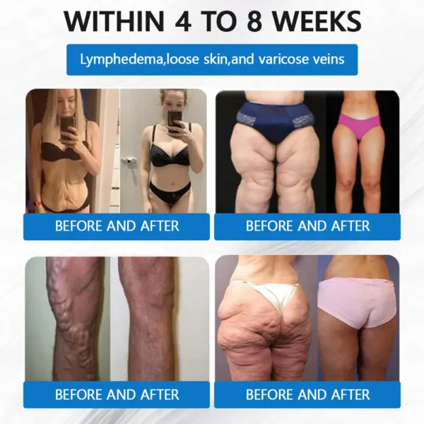 LERCEA® SMGT-GLP-1 Tirzepatide & Collagen Nano Microneedle Weight Loss Patch