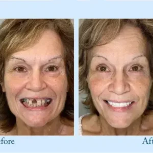 TrueEase™ Dentures